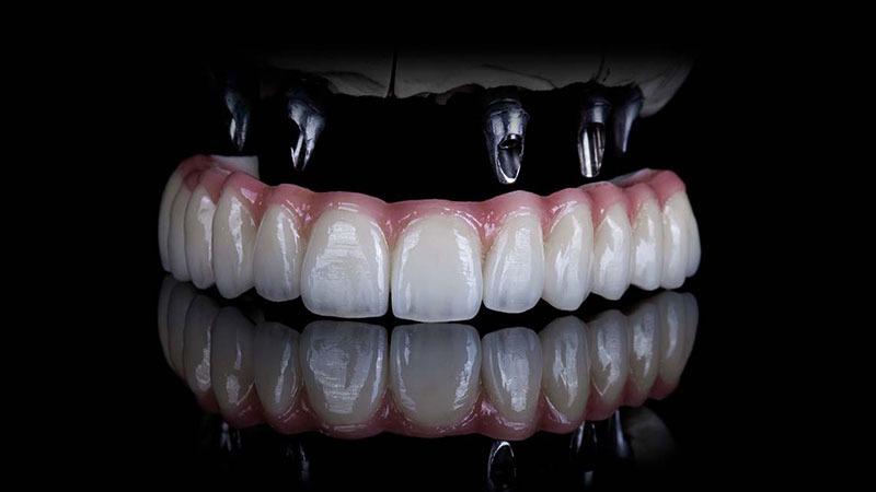 Yapay Diş Yerleştirme